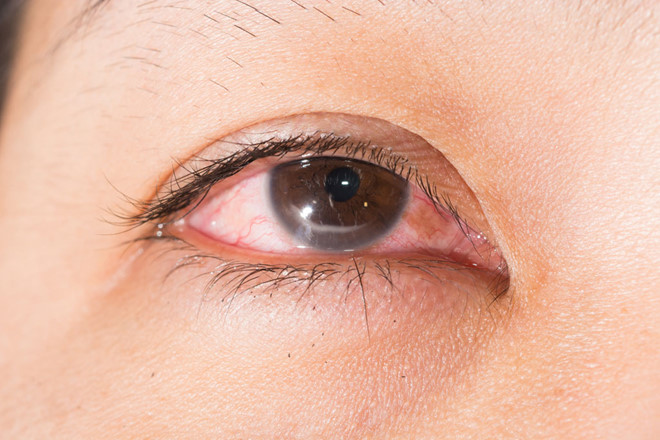 Loét giác mạc là một trong các bệnh về mắt khá phổ biến ở các nước đang phát triển. Một trong những nguyên nhân chính của các bệnh về mắt này chính là thiếu vitamin A trong chế độ ăn uống hàng ngày. Bên cạnh đó điều kiện thời tiết nóng ẩm cũng là nguyên nhân gây loét giác mạc. 
